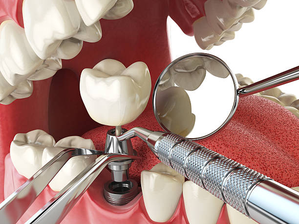 Best Urgent Care for Lost Fillings or Crowns in Edgewater, NJ